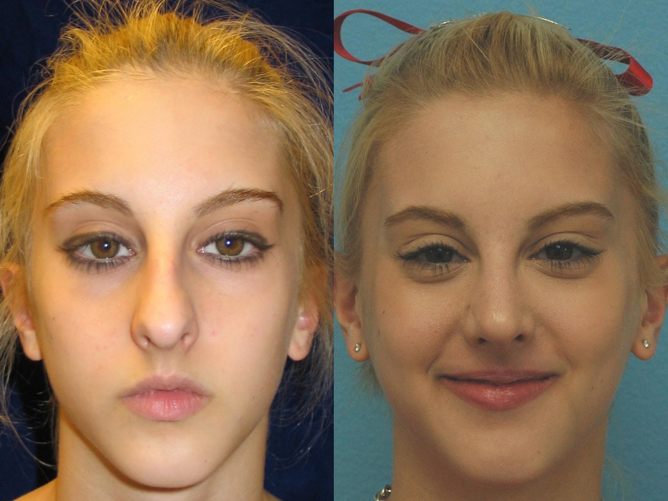 rhinoplasty experts